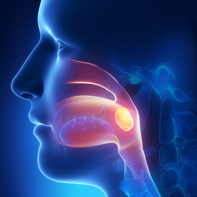 Illustration of enflamed tonsils in throat, representing tonsillectomy